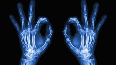 ”صدفة” أنقذت عظام ملايين البشر على مدار 125 عامًا