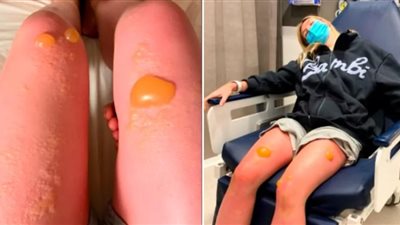 أسترالية تٌحذّر من أمر يفعله الكثيرون: جعلني أهلوس مثل كائن فضائي