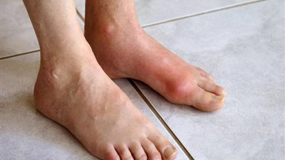 لمرضى النقرس..إحذروا هذه الأغذية