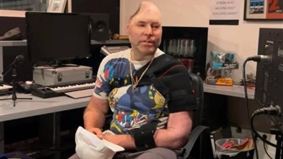 ضحية ”الذهب النازي”.. مطرب راب فقد نصف جمجمته في انفجار معمل مخدرات