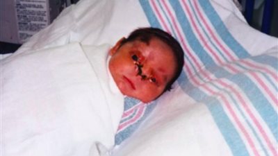 بالصور.. طفل وٌلد بلا أنف أو جفوه وهكذا فاجئ الجميع بعد 22 عامًا