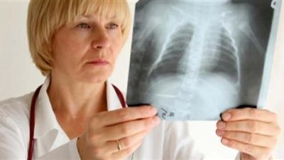 السل .. المرض المعدي الأكثر فتكاً رغم القدرة على تفاديه وعلاجه