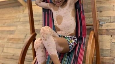 طفل يتوظف في شركة أزياء بسبب حالة وراثية نادرة في الجلد