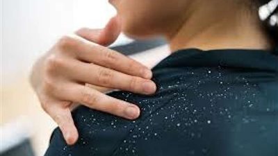 وصفات طبيعية للتخلص من قشرة الشعر نهائيا