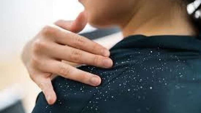 علاج قشرة الشعر بالمنزل