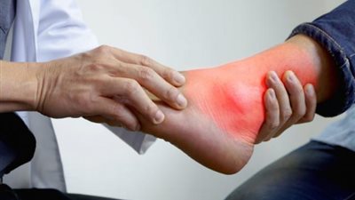 خلى بالك.. هذه الأطعمة تسبب نوبات النقرس