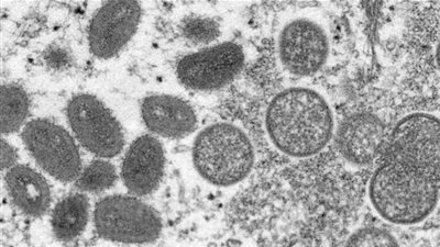 جدري ألاسكا يُرعب العالم .. تعرّف على أعراضه وطرق انتشاره