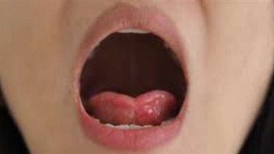 بلع اللسان.. هل هو أمر خطير وماذا تفعل عند حدوثه ؟
