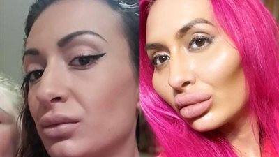 «باربي الحقيقية».. حقائق صادمة عن صاحبة أكبر خدود في العالم