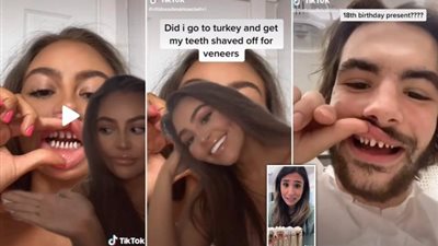 أطباء أسنان ينشرون أسرار وفضائح ”ابتسامة هوليوود”..  ستضطر لتركيب طقم أسنان