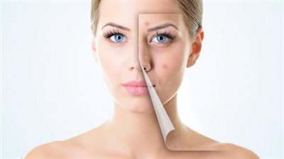 حيل سحرية لبشرة خالية من حبوب الشباب