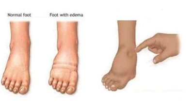 روشتة علاجية سحرية للتخلص من احتباس الماء في الجسم