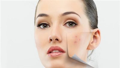 حيل سحرية مذهلة لإخفاء بثور الوجه بالمكياج