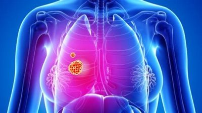 الجمعية الأمريكية للسرطان: صوت الضحكة مؤشر لمرض خطير