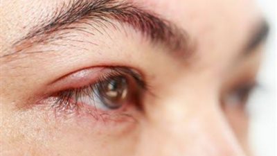 روشتة سحرية لعلاج دمل العين بدون أدوية