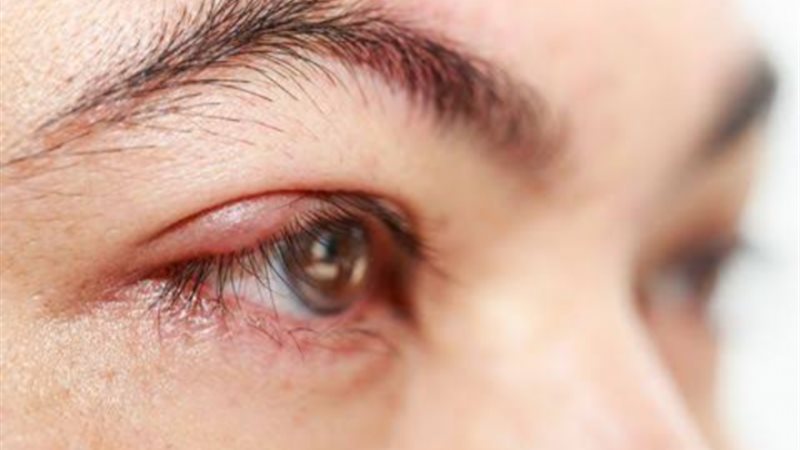 علاج دمل العين