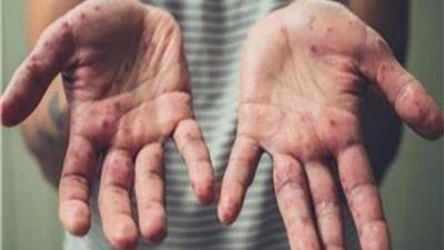 حقيقة إلغاء امتحانات نهاية العام الدراسي 2024 بسبب انتشار جدري الماء بين طلاب المدارس