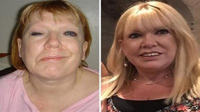 حقنة بوتكس تغير حياة إمرأة لأفضل حال.. عاشت 19 عام بوجه يعاني الشلل