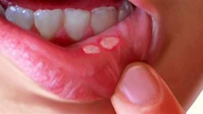 يصيب الأطفال والرضع.. ماهو فيروس الهربس الذي حذرت الصحة منه؟