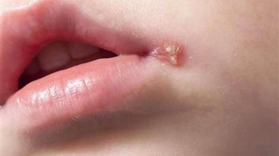 بعد أن تخطى سعر اللقاح 4000 جنيه.. معلومات قد لا تعرفها عن مرض الهربس وأعراضه