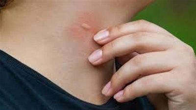 ”مرض خطير”.. نصائح تحميك من الإصابة بالملاريا