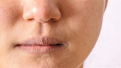 4 عادات يومية تحميك من جفاف الجلد في الشتاء