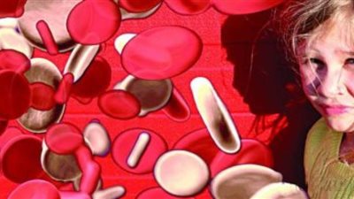 في اليوم العالمي له.. كل ما تريد معرفته عن مرض الثلاسيميا