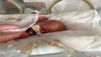 «وصفوه بـ زجاجة الكاتشب».. «أصغر طفل في العالم » يعود إلى الحياة فما قصته؟