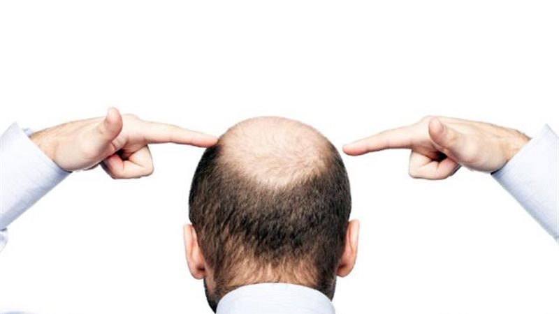 أطعمة تسبب الصلع