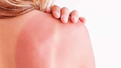 نصائح سحرية للحماية من حروق الشمس.. تعرفي عليها