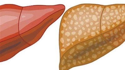 فاكهة صيفية تمنع  تطور تليف الكبد.. تعرف  عليها