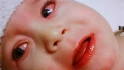 بعد تسجيل أول إصابة بكاواساكي.. تفاصيل مثيرة عن المرض المرتبط بكورونا