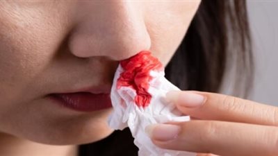 أسباب نزيف الأنف في فصل الصيف.. وطرق العلاج