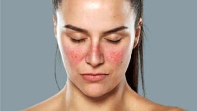 اليوم العالمي للذئبة الحمراء.. ما سببها وطرق العلاج