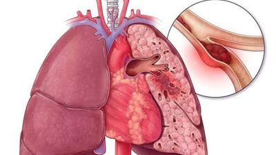 ما هو مرض الانصمام الرئوي؟ وما أعراضه؟