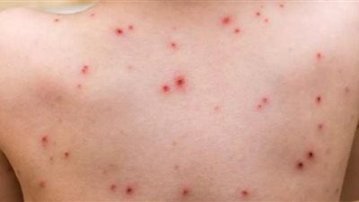 جدري القرود.. كل ما تريد معرفته عن الفيروس النادر