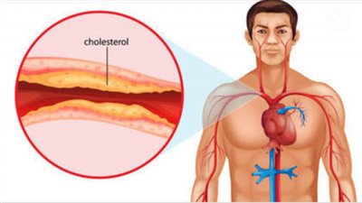 تعرف على الحل السحري لخفض الكولسترول الضار