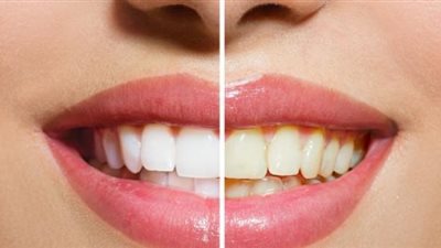إذا كنت من محبي الشاي والقهوة بكثرة.. طرق آمنة لتبييض الأسنان