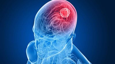 اليوم العالمي لأورام المخ.. تعرف على الأعراض والعلاج
