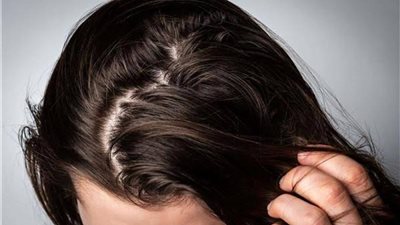 منها خل التفاح.. وصفات طبيعية لتنظيف الشعر الدهني في الصيف