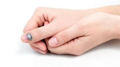 التعرض للرطوبة والماء.. هذه أسباب فطريات الأظافر