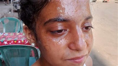 تطورات حادث الطالبة كارولين صاحبة واقعة المياه المغلية