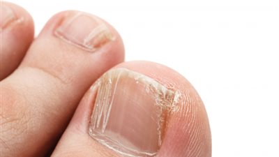 8 أسباب لظهور فطريات الأظافر...تجنبها