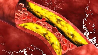 بعد وفاة طيار مصري.. ما هي علامات ارتفاع مستوى الكوليسترول