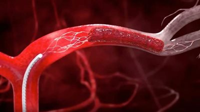 في يومها العالمي.. أعراض ومخاطر الأنيميا المنجلية وطرق علاجها
