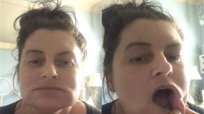 حكاية السيدة التى حولتها حقنة تجميل إلى «رجل الفيل»