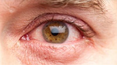 بدون أدوية.. روشتة سحرية طييعية لعلاج «عوامات العين»