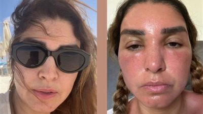 روجينا تتعرض لحرق في وجهها وتبعث رسالة لجمهورها