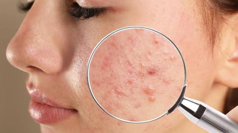 علاجات منزلية لحبوب