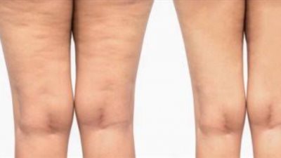 تخلصي من السيلوليت نهائيا بهذا المشروب المذهل